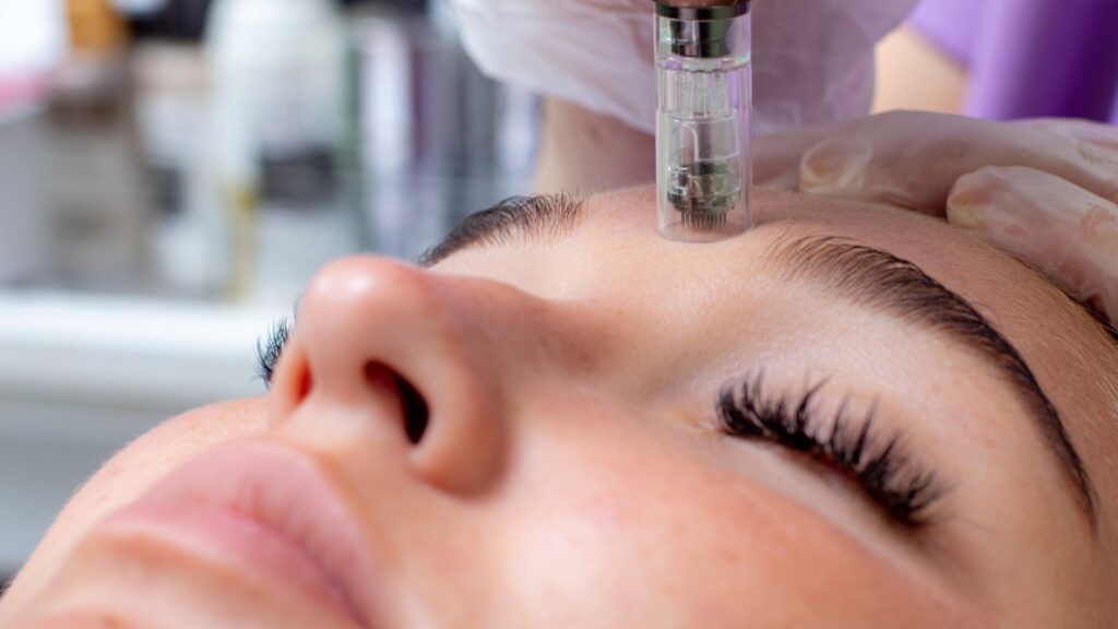 Close-up of a woman receiving a microneedling treatment on her forehead from a professional.