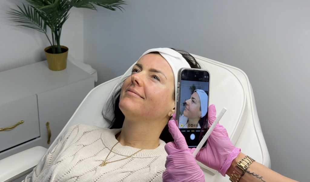 Microneedling Derma 2.0 Skin Booster Flawless Clinic Wellington